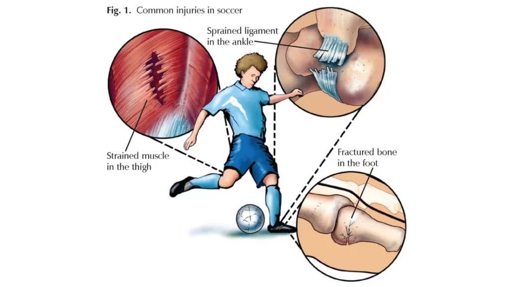Preventing Common Soccer Injuries: Physio Labs Expert Tips for Injury