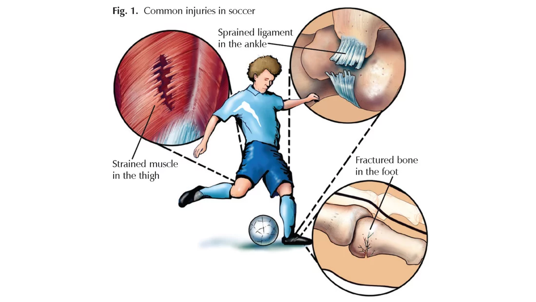 Football Player Injuries: Prevention and Treatment